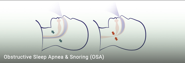 Obstructive Sleep Apnea & Snoring (OSA)